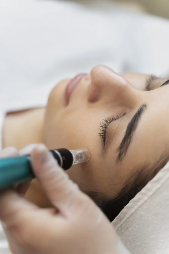 Microneedling φωτογραφία